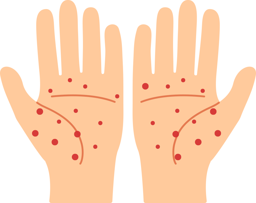 掌蹠膿疱症のイメージ
