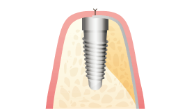 歯肉の縫合