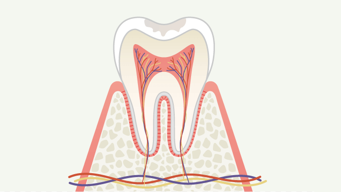虫歯の進行度 C0