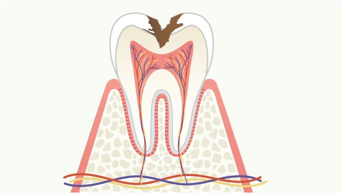 虫歯の進行度 C2