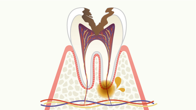 虫歯の進行度 C3